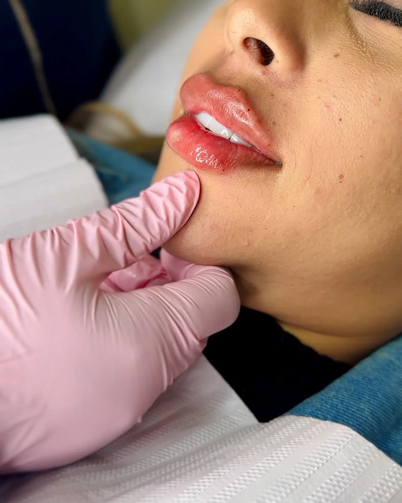 preenchimento labial 1