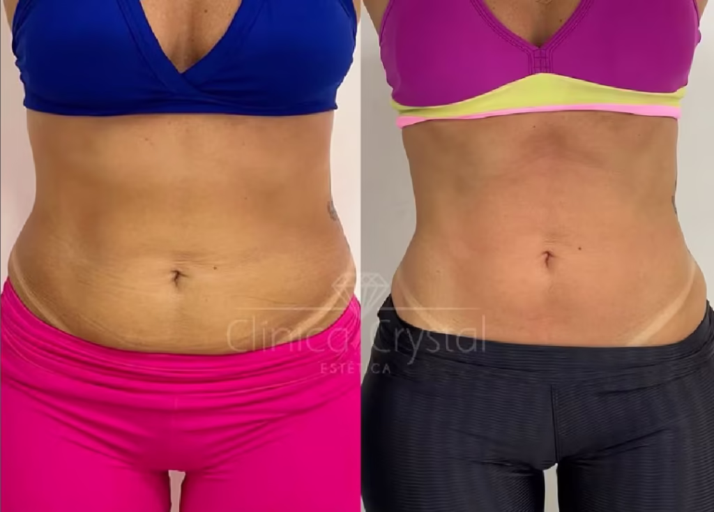 Lipo Enzimática